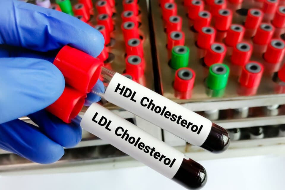 Good” cholesterol may increase the risk of dementia • Earth.com
