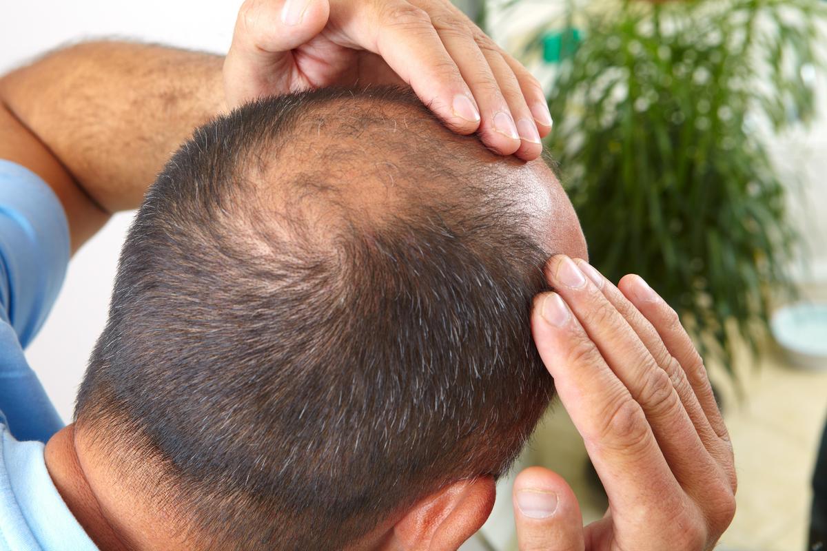 New discovery explains cause of baldness, hair loss