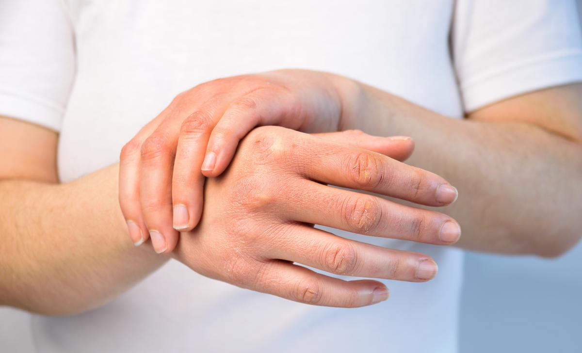Why your skin can get so dry during the winter