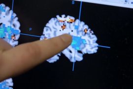 A lack of sleep intensifies pain