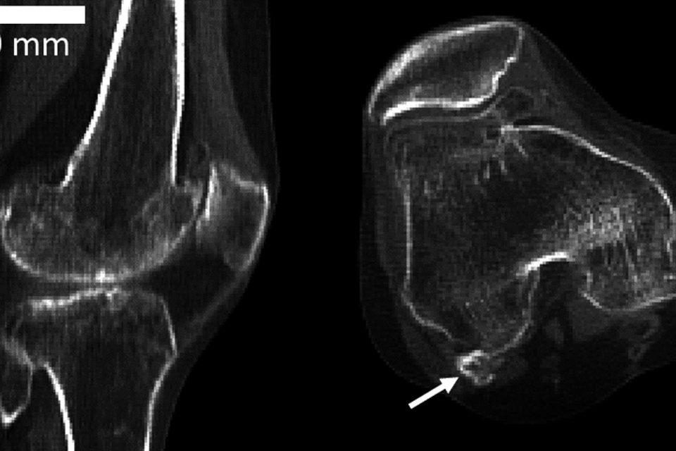 'Extra' knee bone on the rise thanks to modern diet
