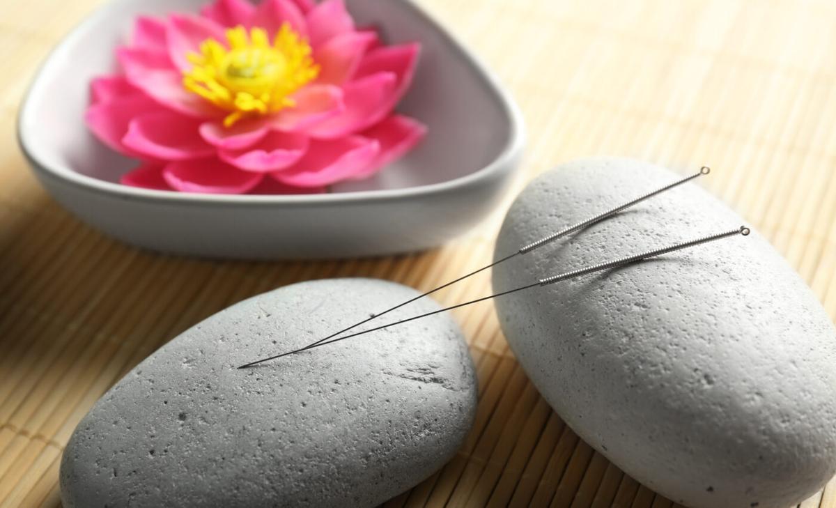 Acupuncture is a potential treatment for debilitating headaches