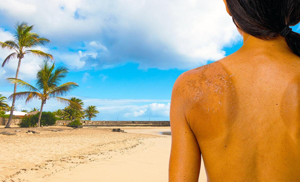 Why does skin become leathery after too much UV light from sun exposure?