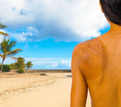 Sunburned,Brunette,Woman,Back,On,Sunny,Beach,With,Copy,Space.