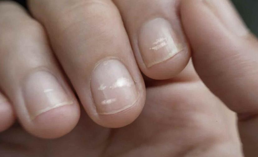 White stripes on your nails what does that mean Earth com