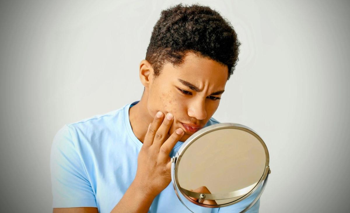 Teen skin bacteria could hold the secret to acne prevention
