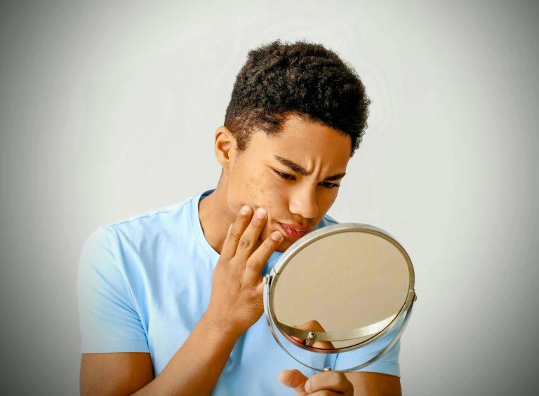 2025/05/Acne-skin-bacteria.jpg
