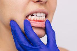 2025/06/gum-disease3.jpg