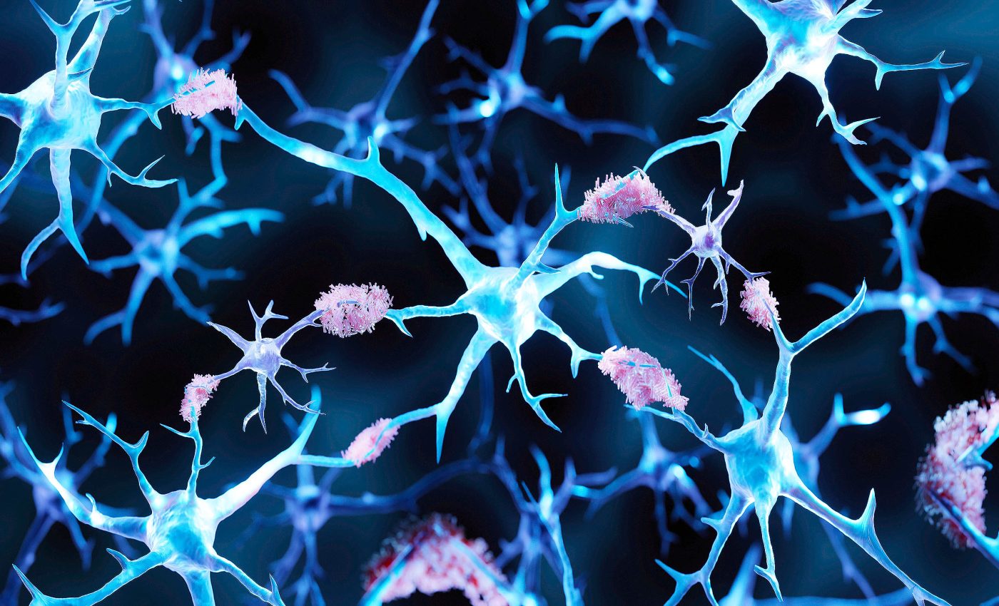 Youngest person to ever get Alzheimer’s disease has given scientists new clues