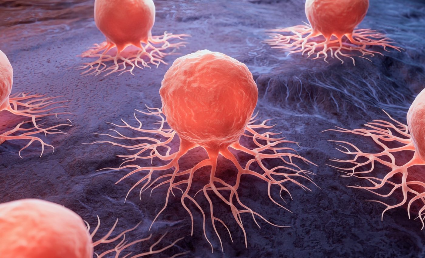 Cancer deaths to rise 75% by 2050 - what’s driving the surge?