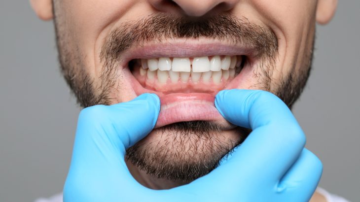 Can teeth rebuild themselves? A new gel could make it possible