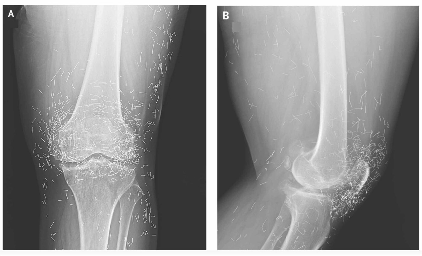 Woman's knee pain was caused by gold threads in her joints left behind by acupuncture
