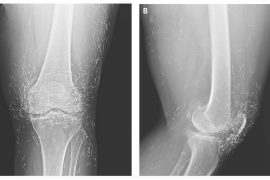 2025/11/knee-pain-xray-gold-threads-discovery.jpg