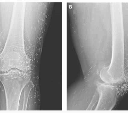 2025/11/knee-pain-xray-gold-threads-discovery.jpg