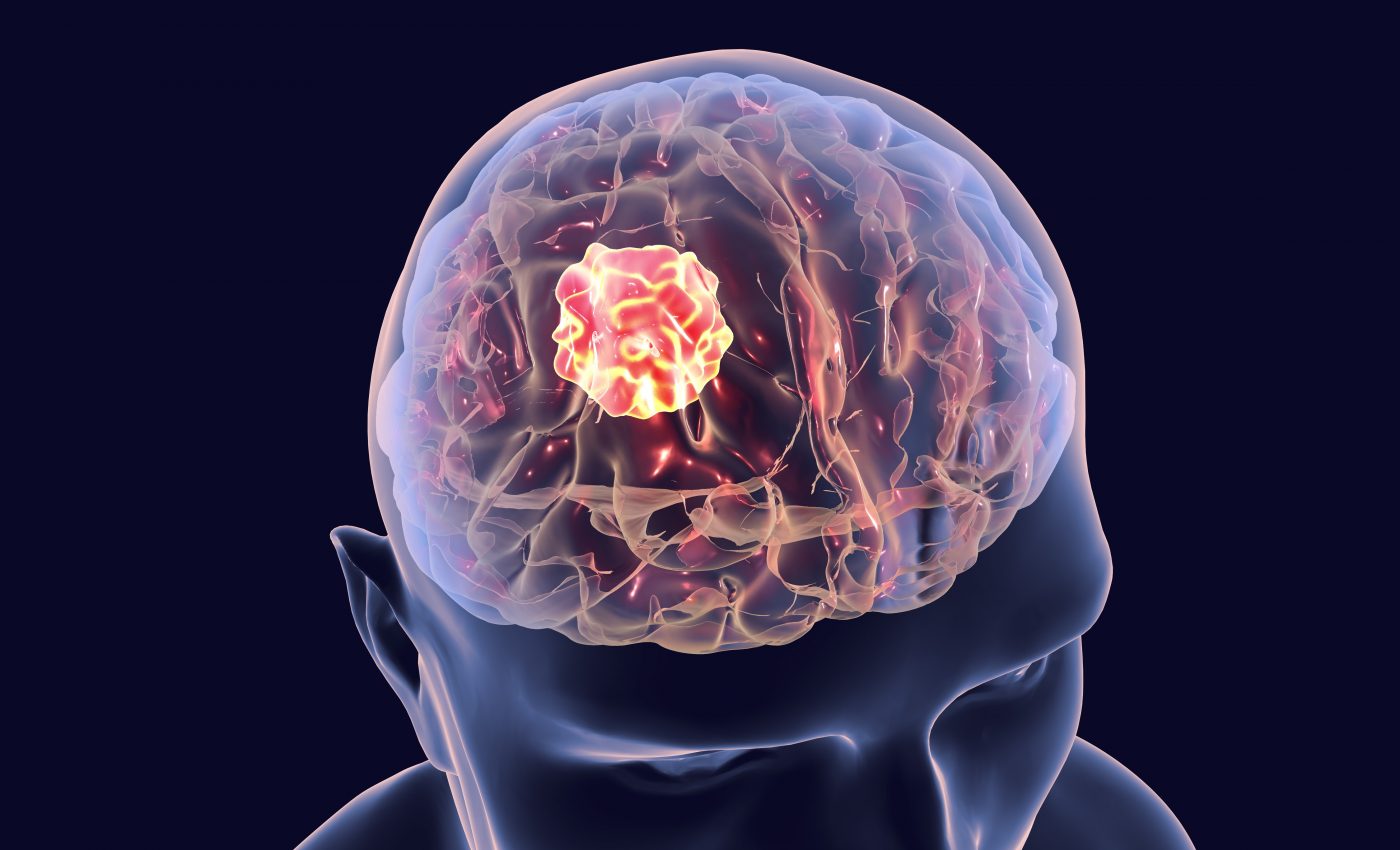 Brain tumor severity and survival may be dependent on sex