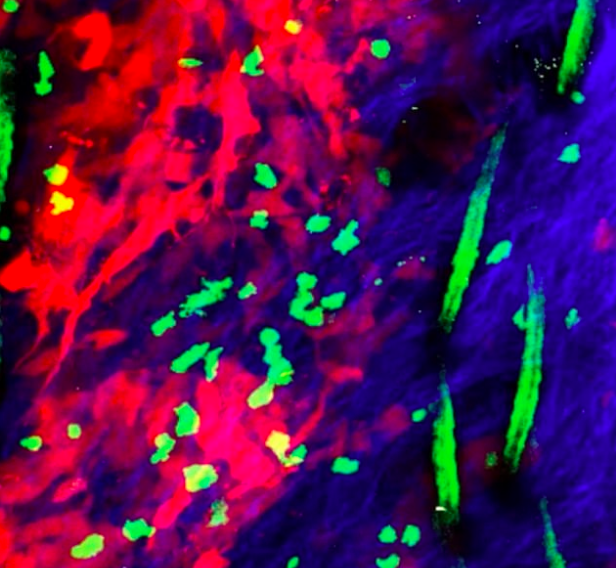 Immune cells may hold the key to breakthrough skin cancer treatment