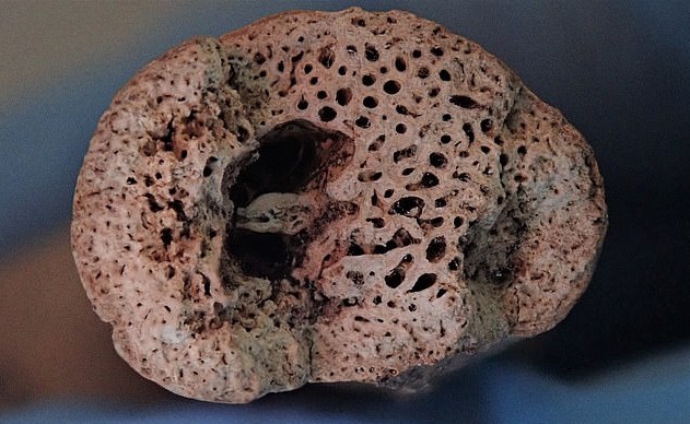 Medieval skeletons reveal bone disease that killed people as young as 35