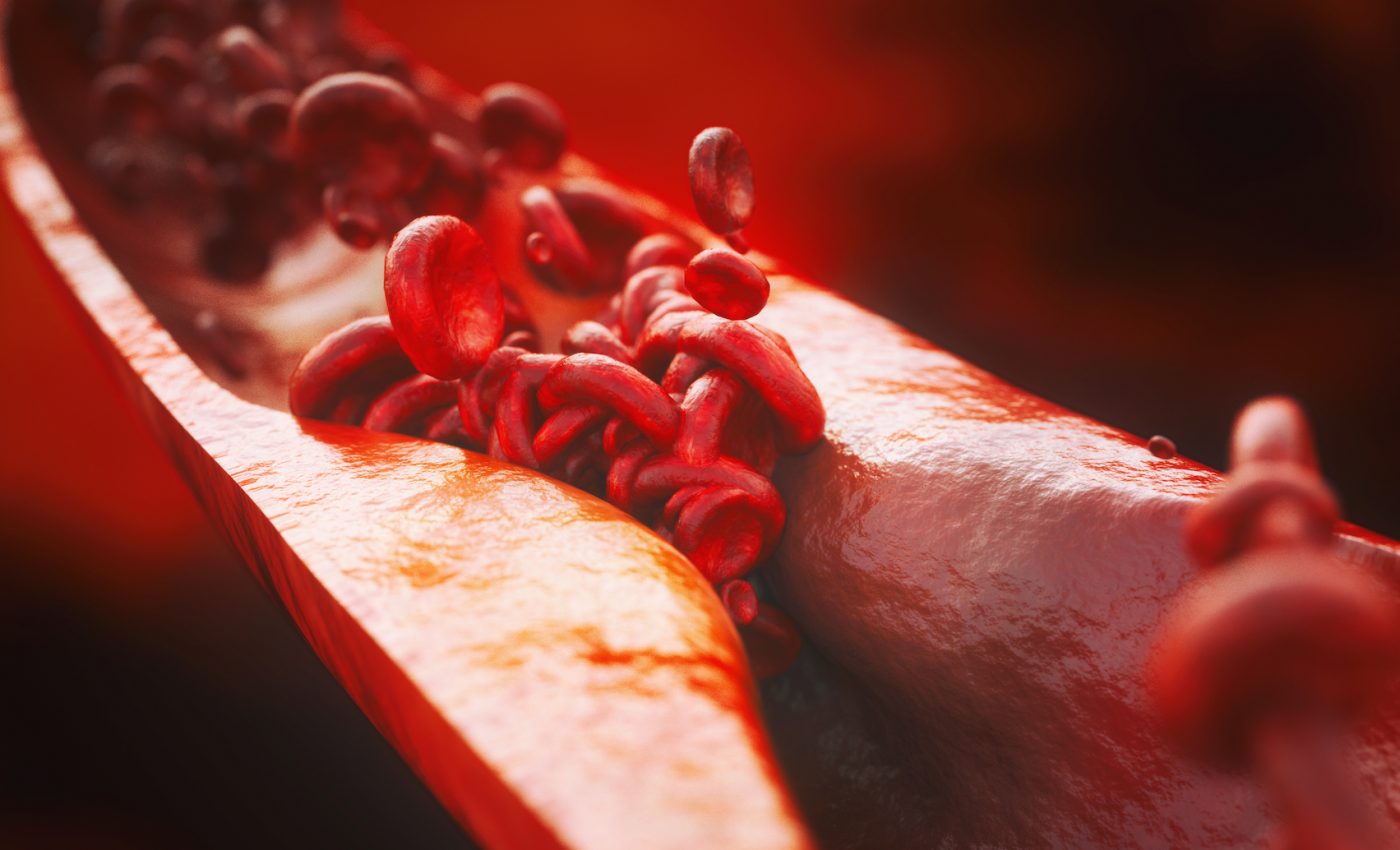 The loss of a single gene could explain why are prone to heart disease