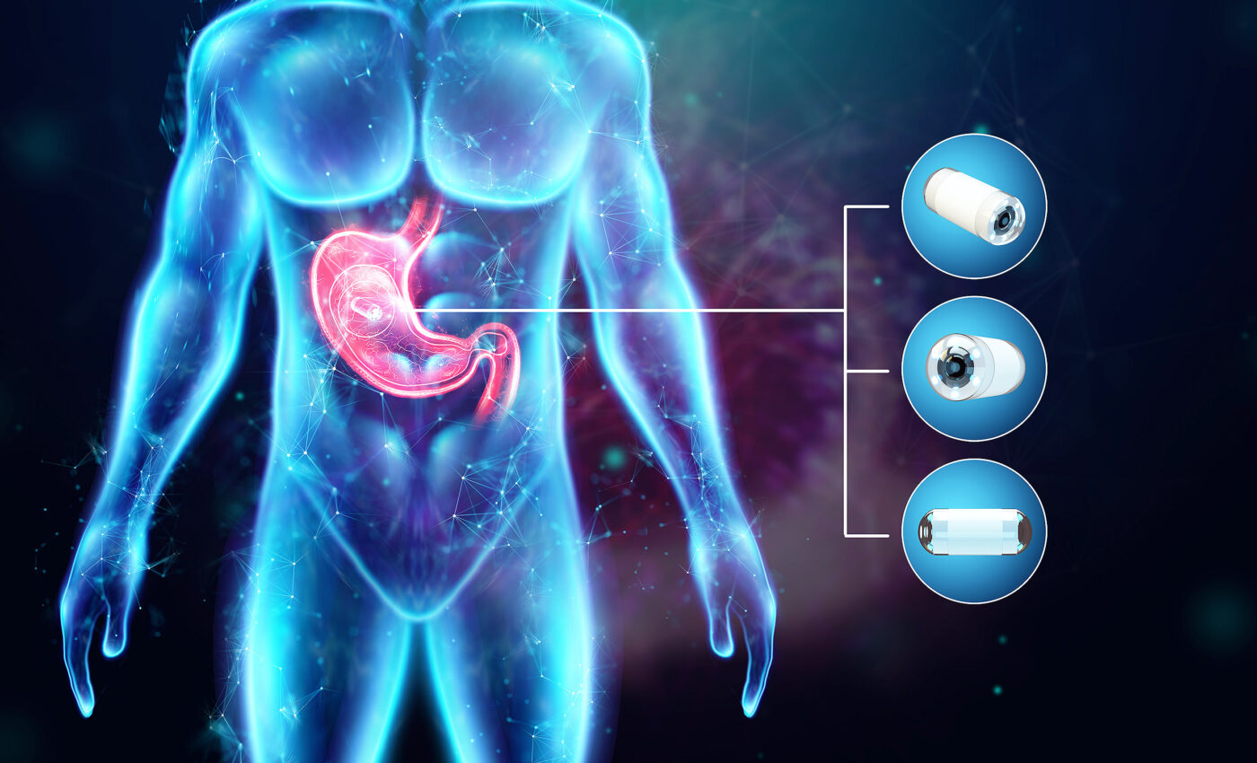 Swallowing a vibrating capsule may revolutionize obesity treatment