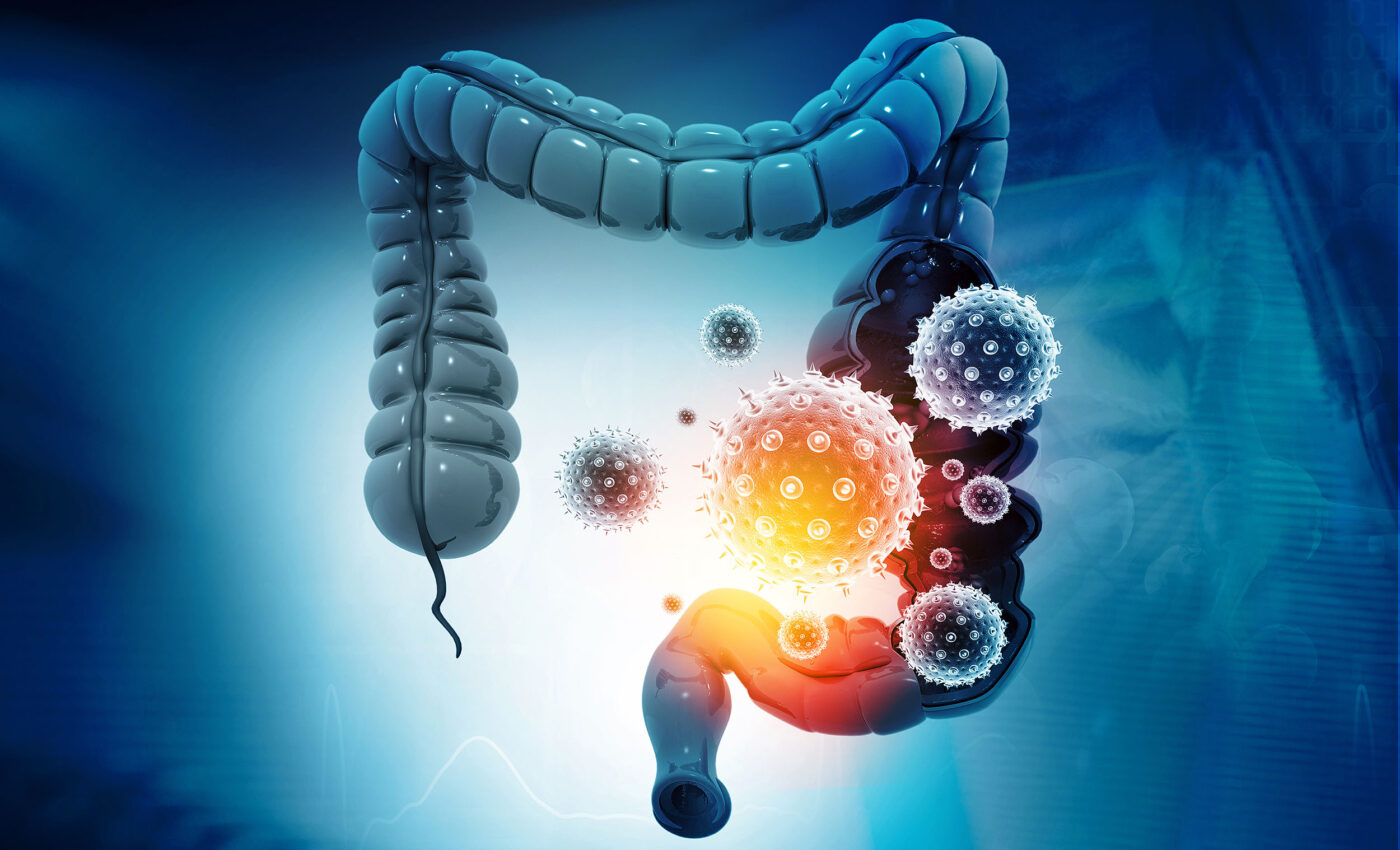 Colon cancer screening will be much easier with accurate new blood test