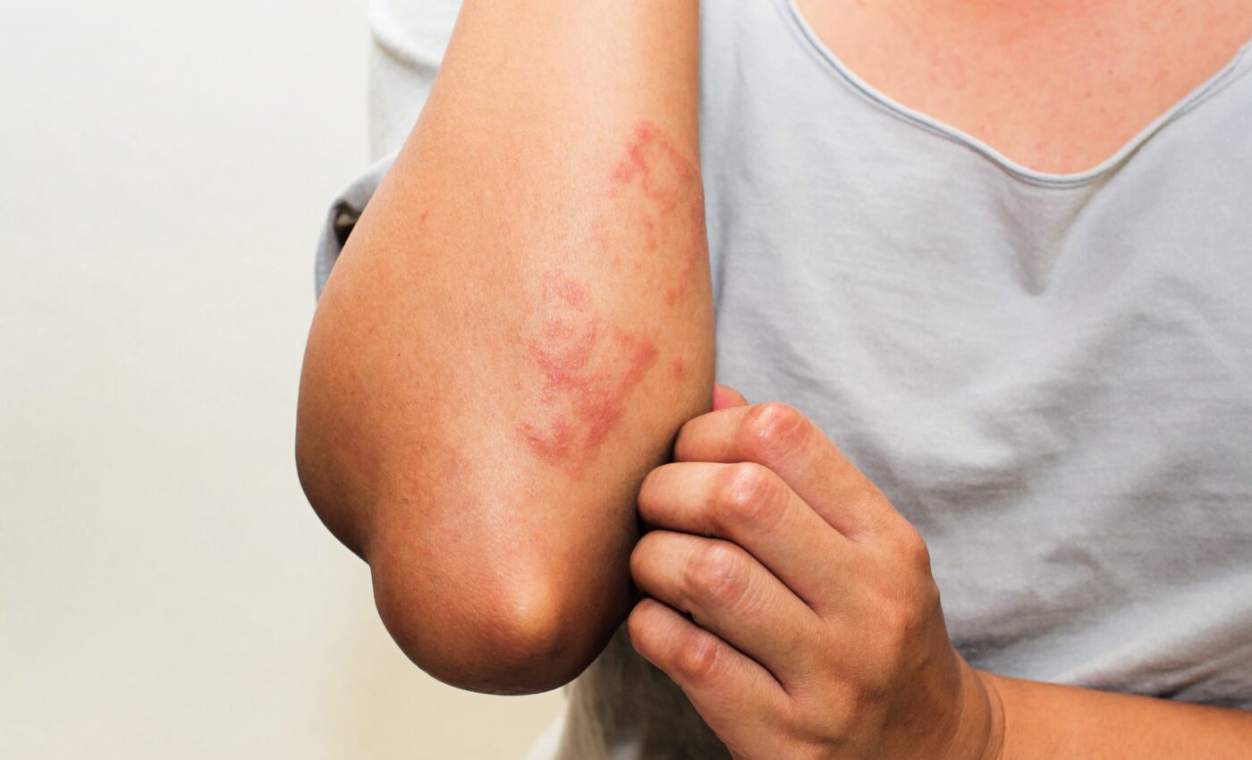 Schistosomiasis treatment improves with newly-discovered compound