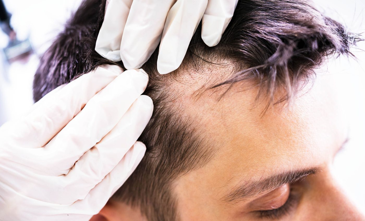 Intermittent fasting can slow hair growth, but it also has many positive health benefits