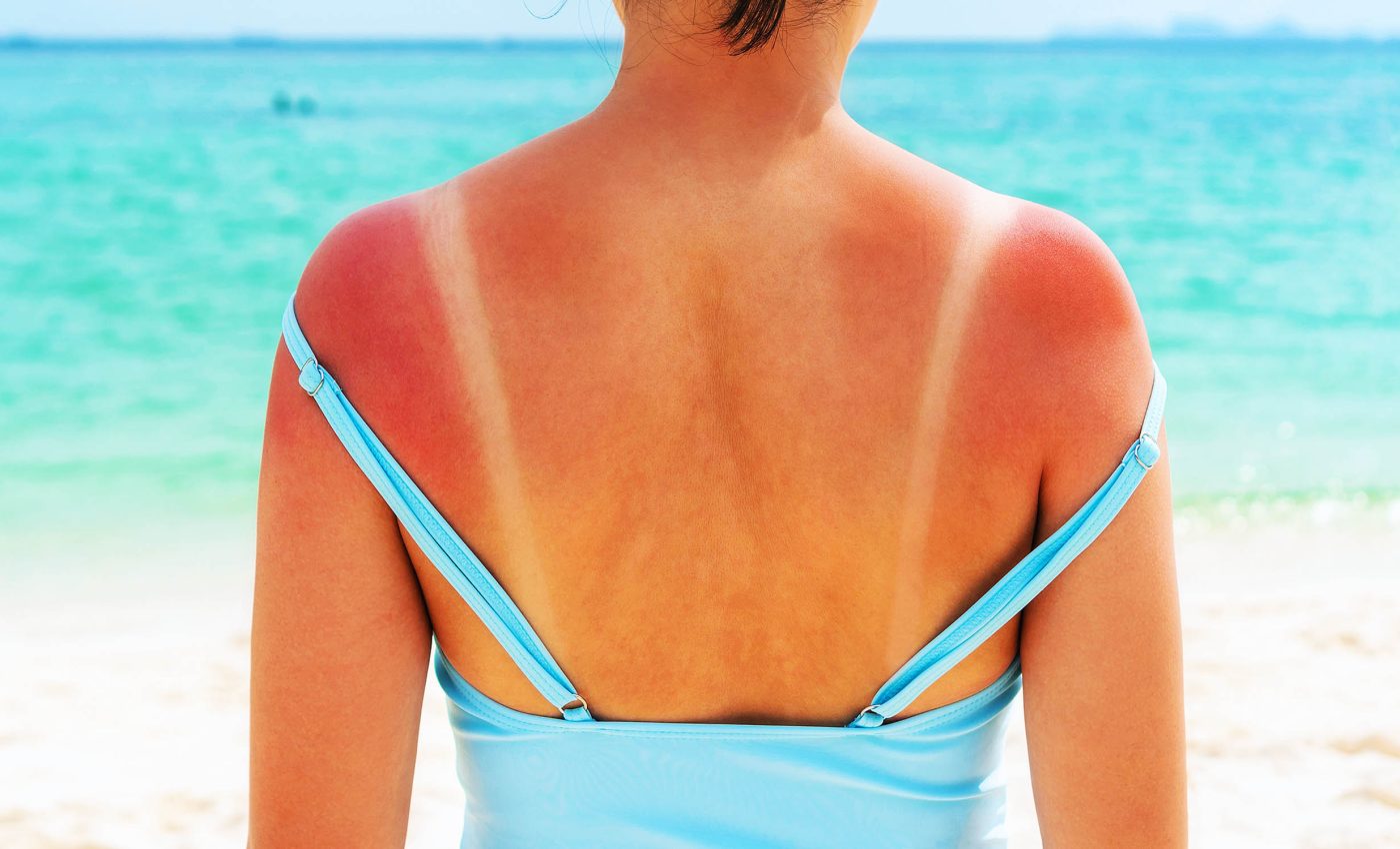 Main cause of sunburn is finally identified, and it's not what we've been told