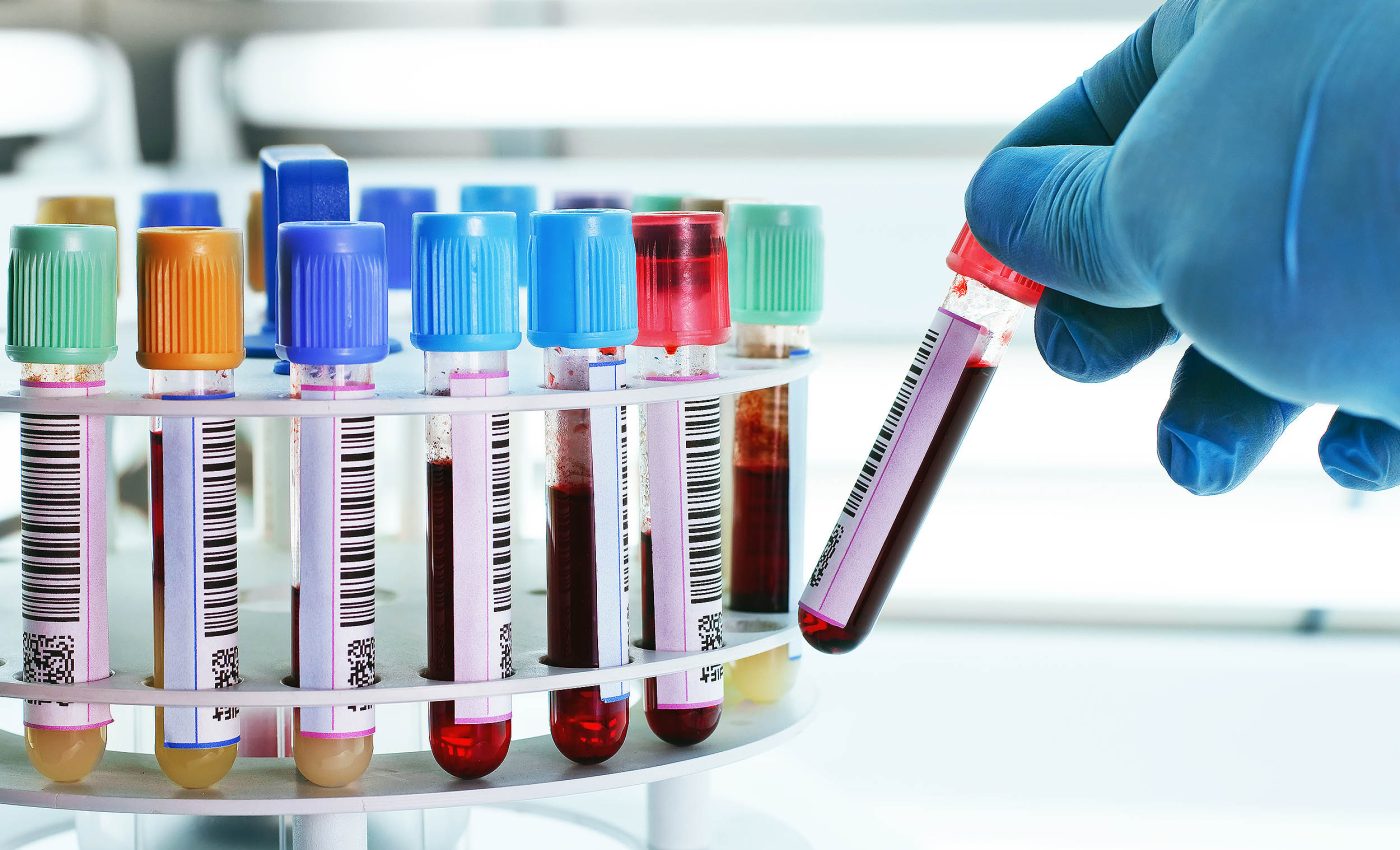 New blood test identifies early-stage Alzheimer's with 90% accuracy