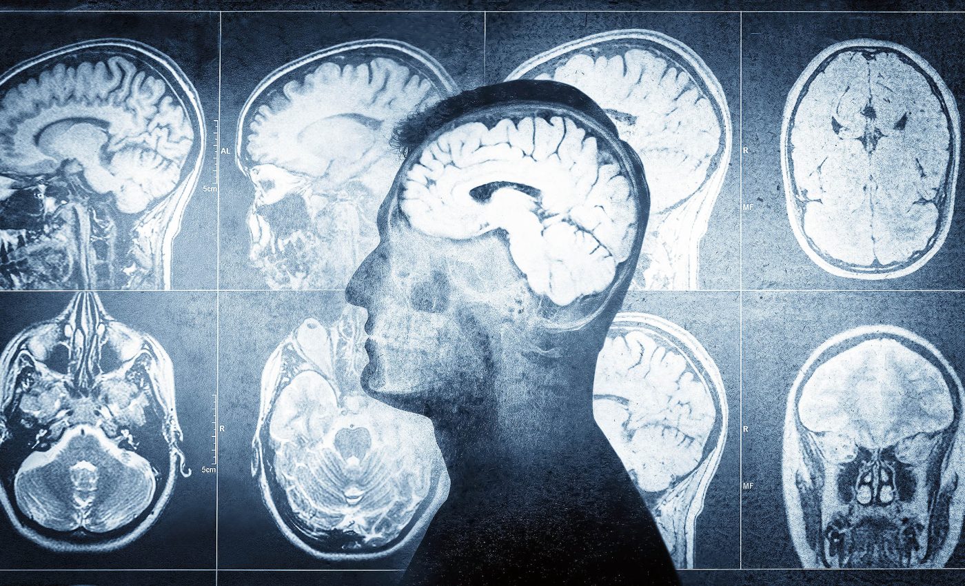 Human brain evolution may explain the rapid increase in autism rates