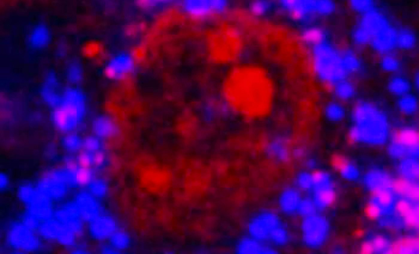 Scientists find microplastics in human bones that are weakening our skeletons