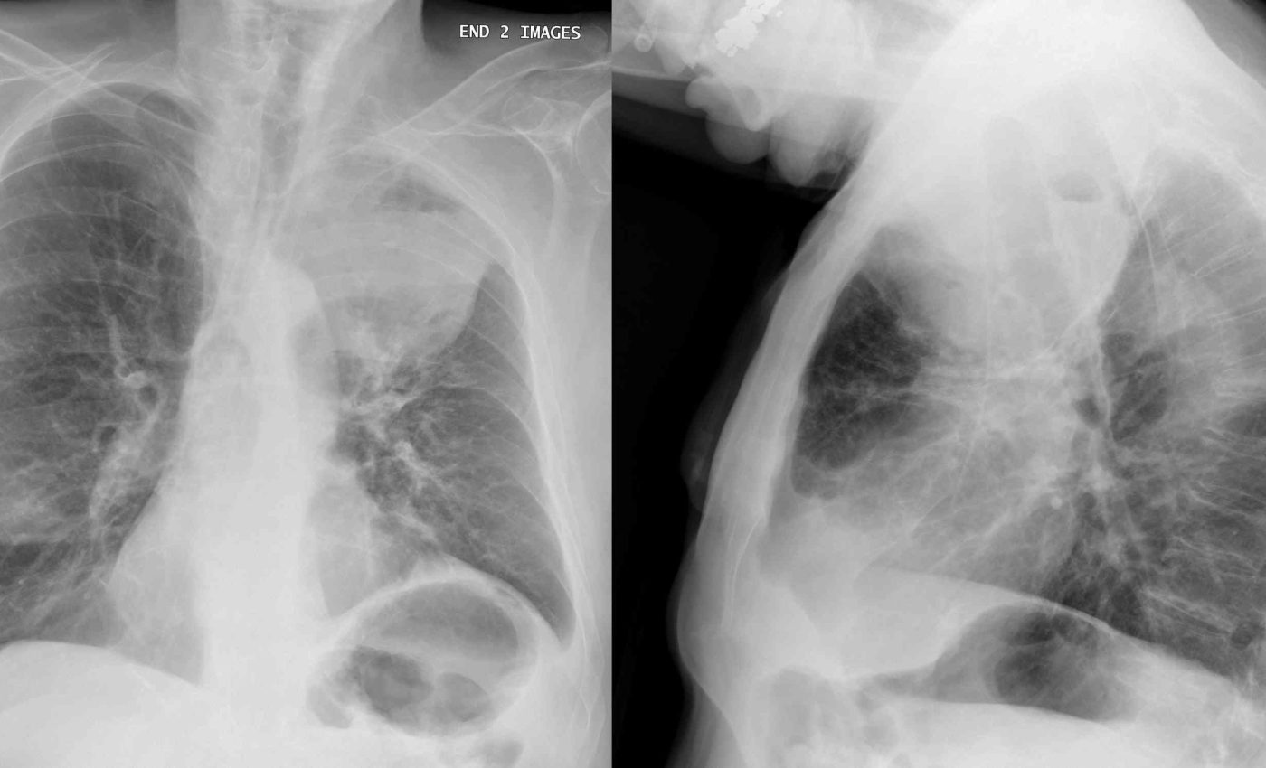New cancer treatment uses two bacteria species without help from the immune system