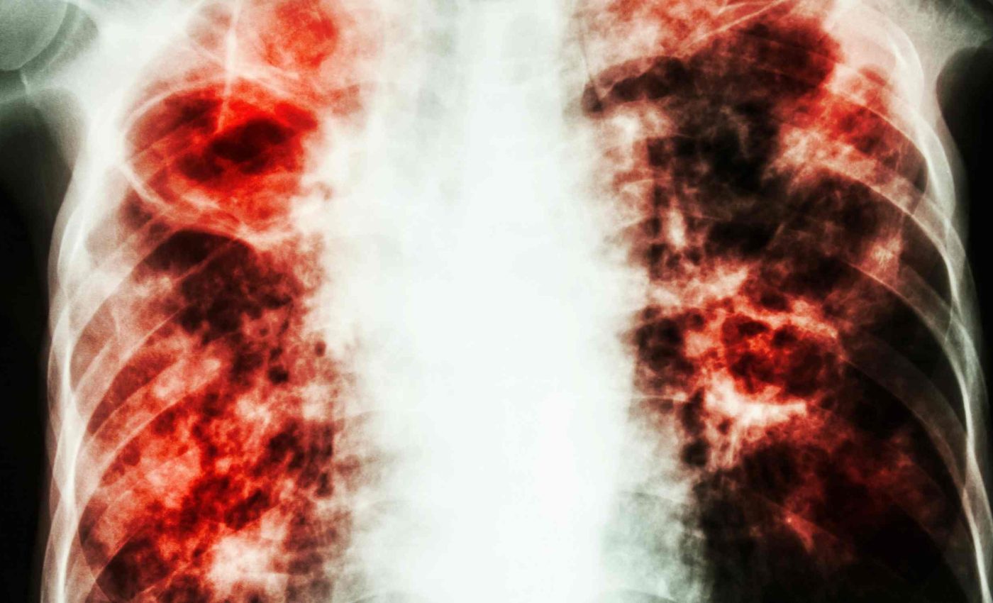 New drug is proving effective at protecting babies from serious respiratory infections