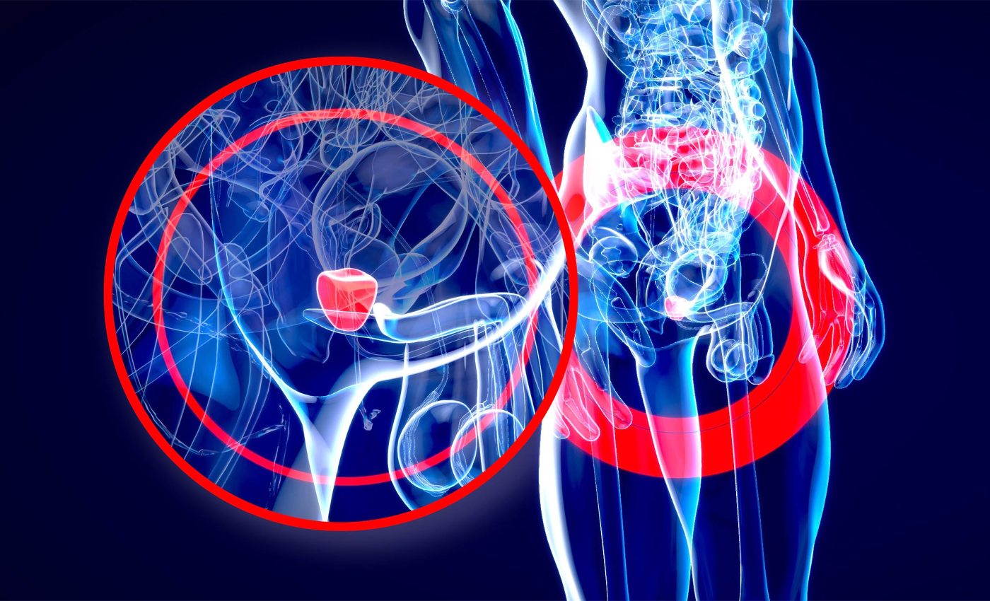New drug combination slows progression of prostate cancer with BRCA mutations