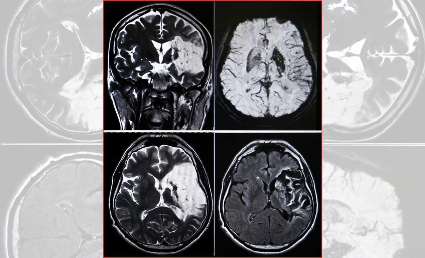Four common factors appear prior to 99% of heart attacks and strokes