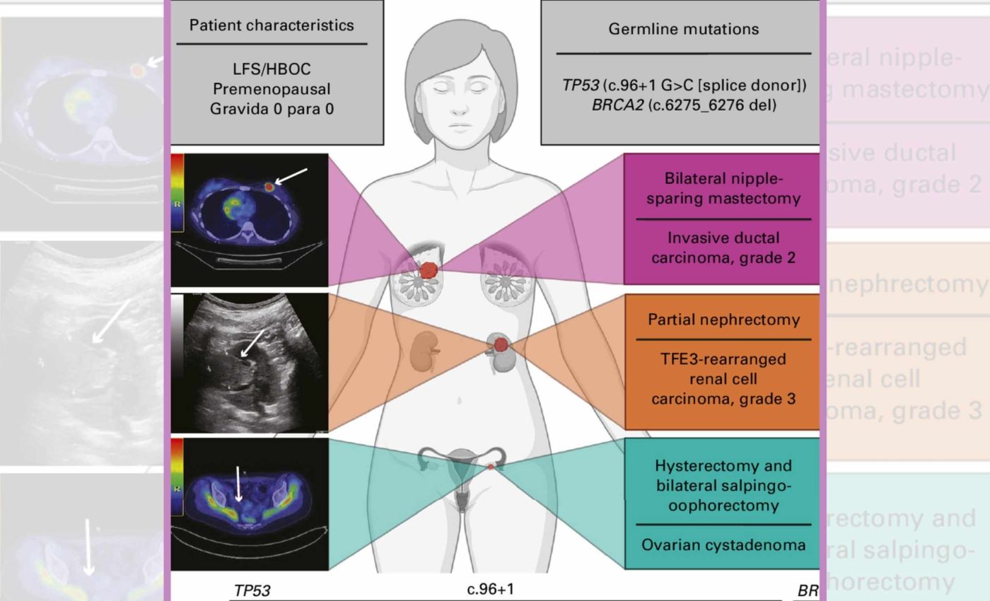 Many women confuse the first symptoms of ovarian cancer with simple weight gain