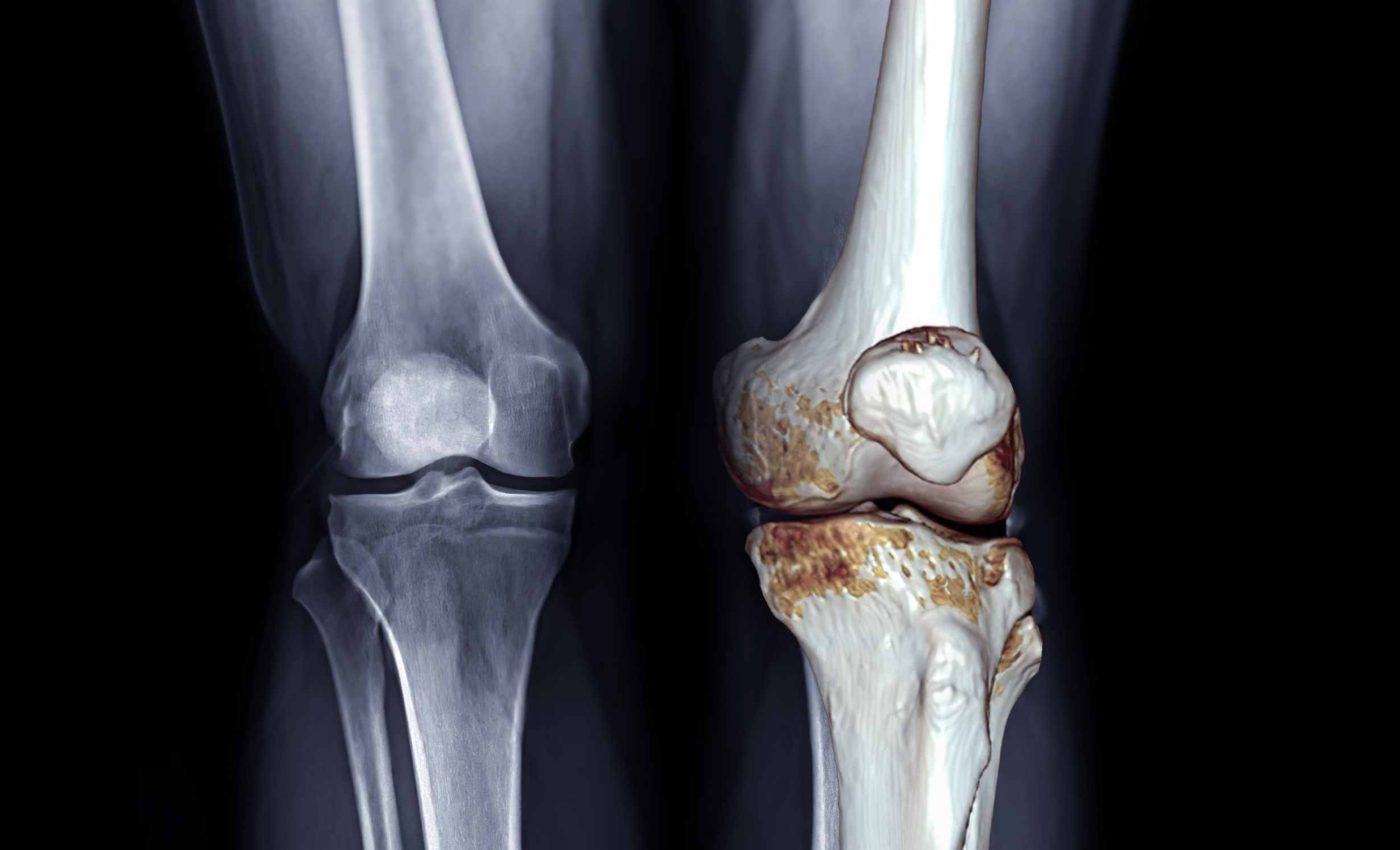 Scientists confirm the best treatments for osteoarthritis are not medications