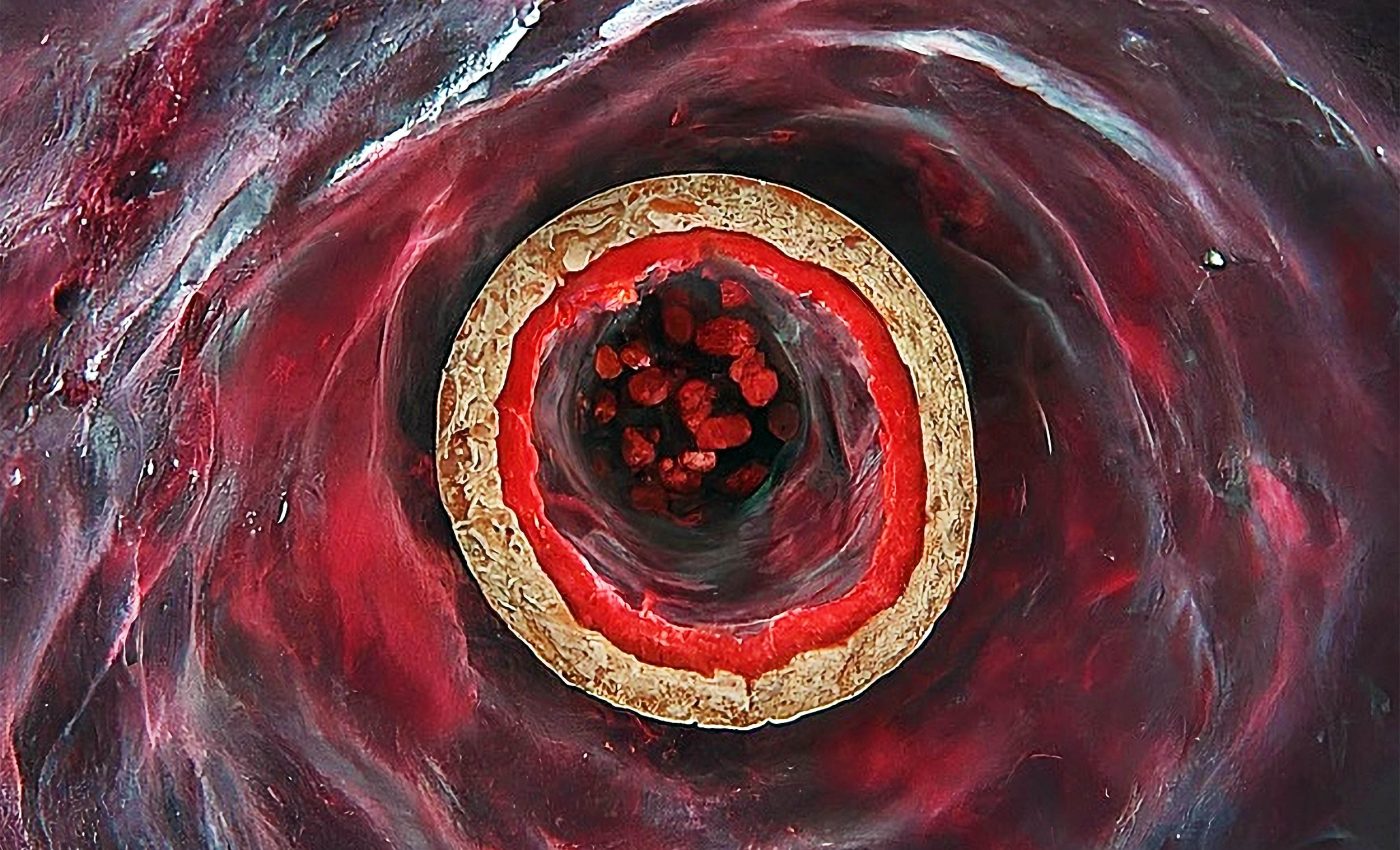 Cutting-edge tech captures images inside human heart arteries, revolutionizing medical science